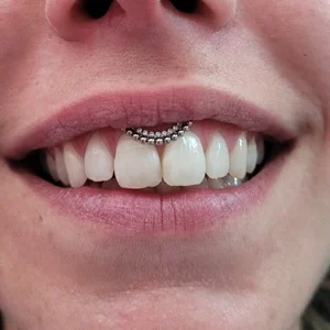 Nordik Piercing: piercing smiley